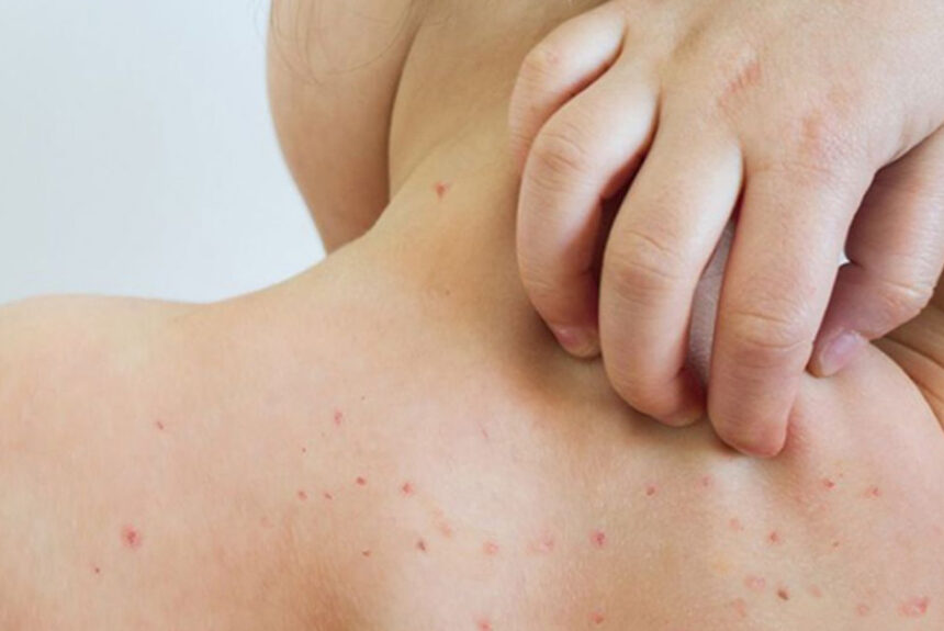 Alerta epidemiológica sarampión Alerta epidemiológica sarampión